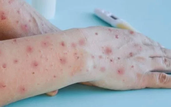 Pernambuco tem transmissão comunitária da monkeypox